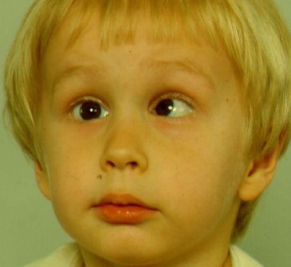 Ребенок косит глазки. Дисбинокулярная амблиопия. Обскурационная амблиопия. Дисбинокулярная амблиопия 1 степени. Косоглазие у детей.